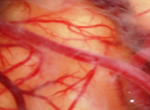 epilepsy reticular encephalopathy ICP surgery of epilepsy